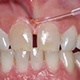 Dentistry fiber optics